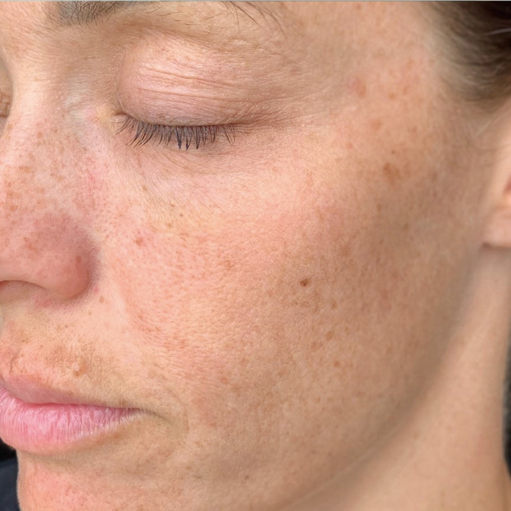 Face before PRP Face Rejuvenation Treatment is dry, damped and has wrinkles