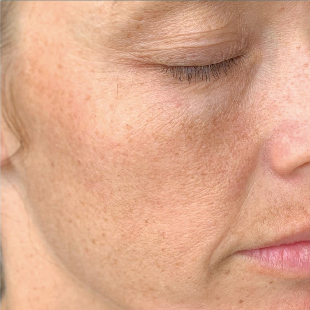 Face before PRP Face Rejuvenation has reduced inflammation and hyperpigmentation