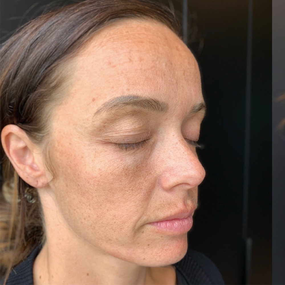 Before PRP Face Rejuvenation Treatment is dry, damped and has wrinkles