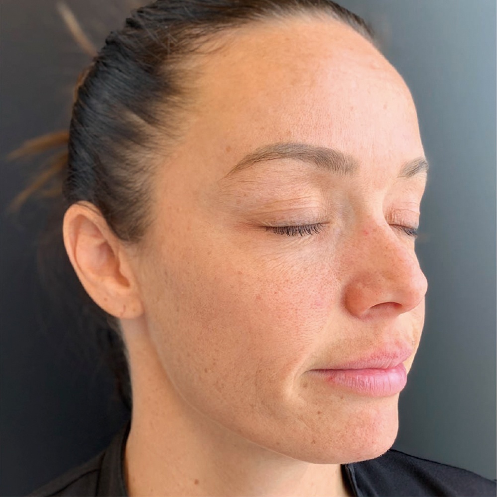 PRP Face Rejuvenation Therapy at CLINIQUE AG - Medical Clinic in Laval, Montreal