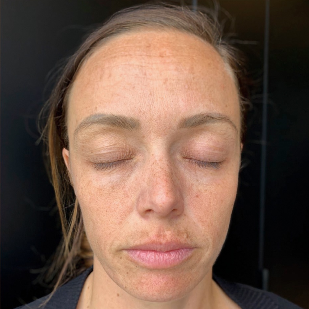 Before PRP Face Rejuvenation Treatment is dry and damped with hyperpigmentation