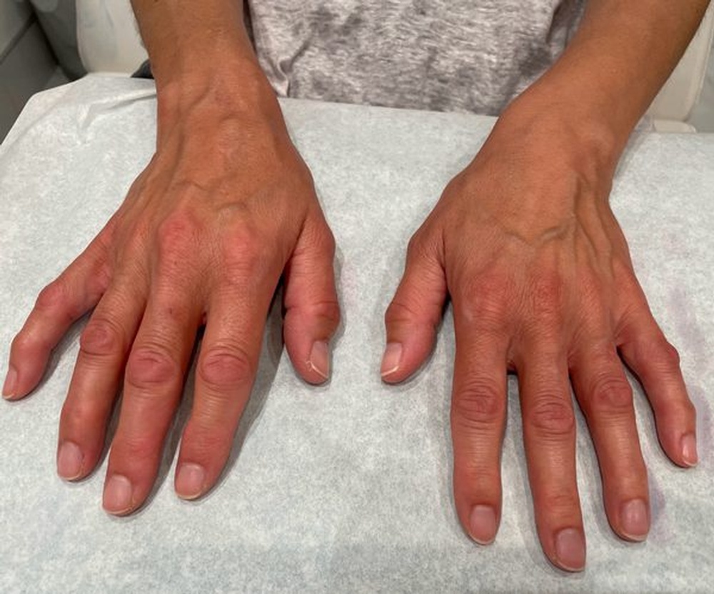 Hands after Skinbooster Treatment at CLINIQUE AG - Medical Clinic in Laval, Montreal