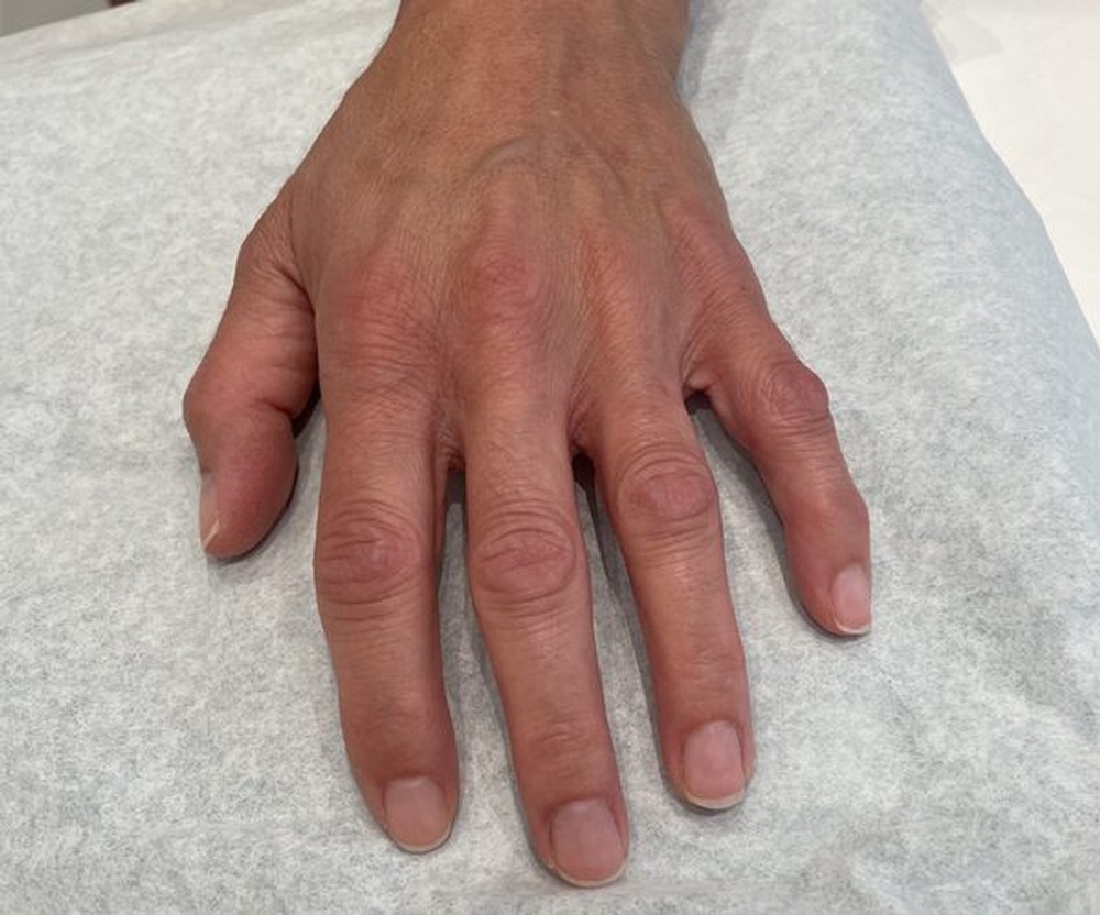 Before Skinbooster Treatment hands have reduced hydration, roughness and fine lines