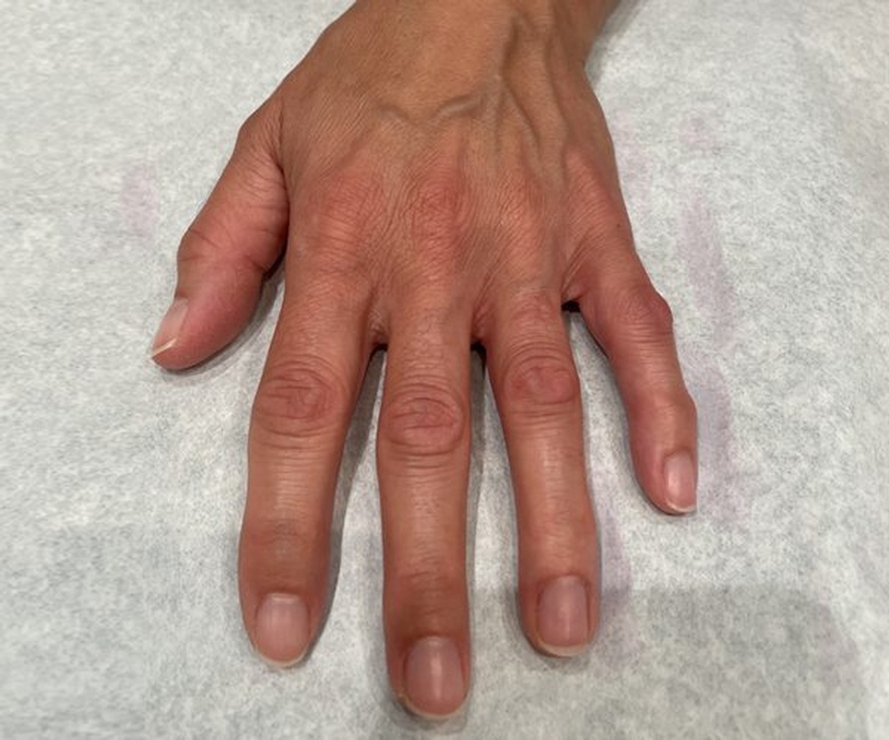 Hands after Skinbooster Treatment at CLINIQUE AG in Laval, Montreal