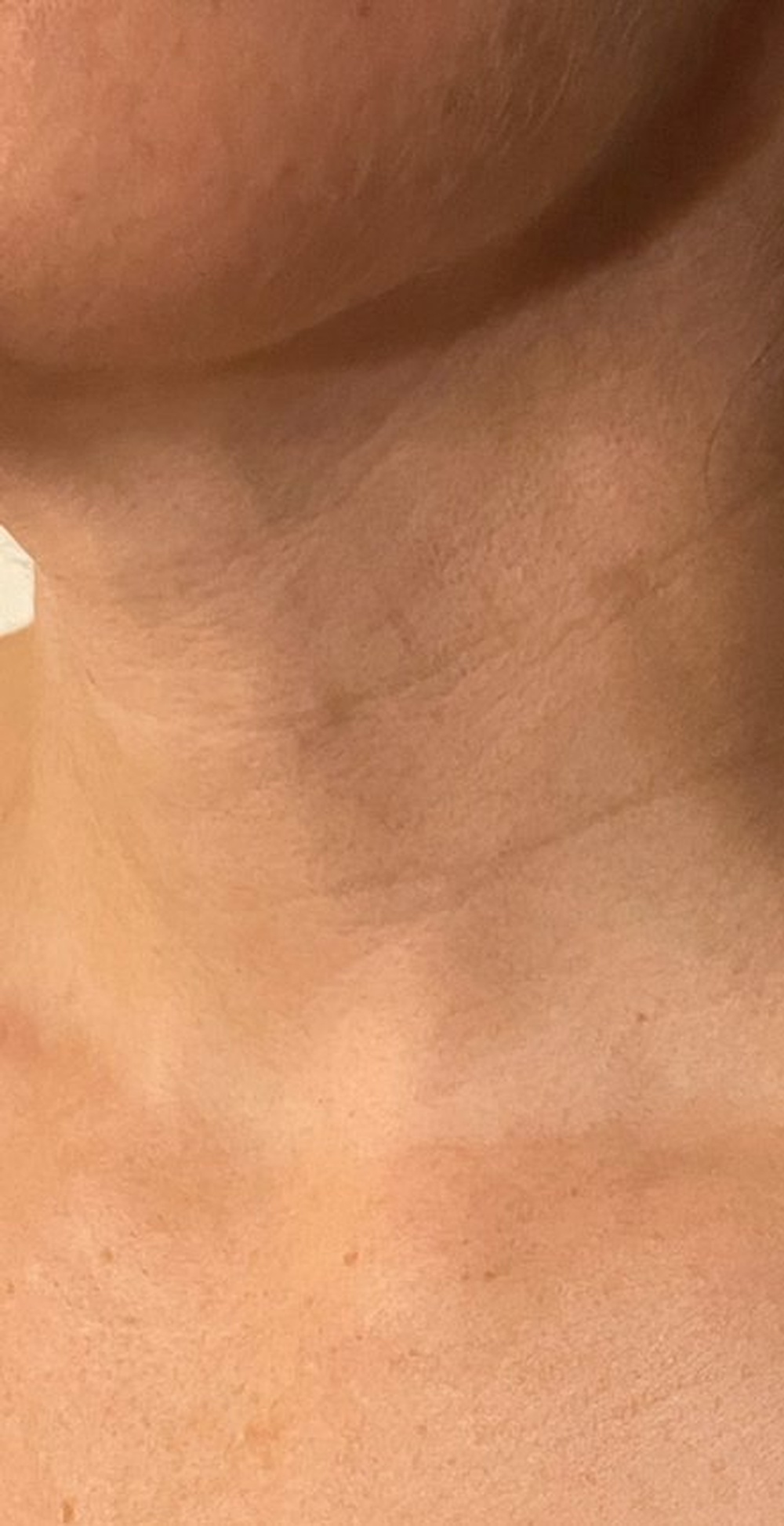 Neck after Skinbooster Treatment at CLINIQUE AG - Medical Clinic in Laval, Montreal