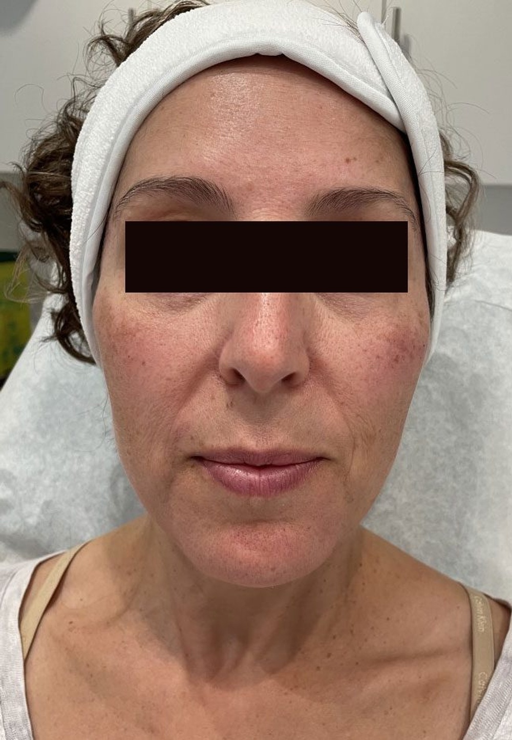 Face before Sculptra Treatment is dry, damped and has wrinkles