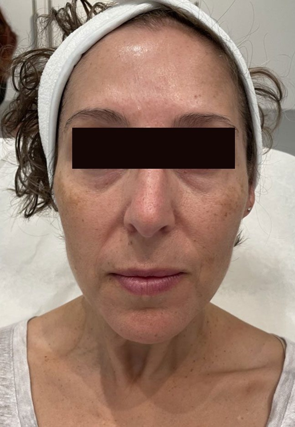Face after Sculptra Treatment at CLINIQUE AG - Medical Clinic in Laval, Montreal