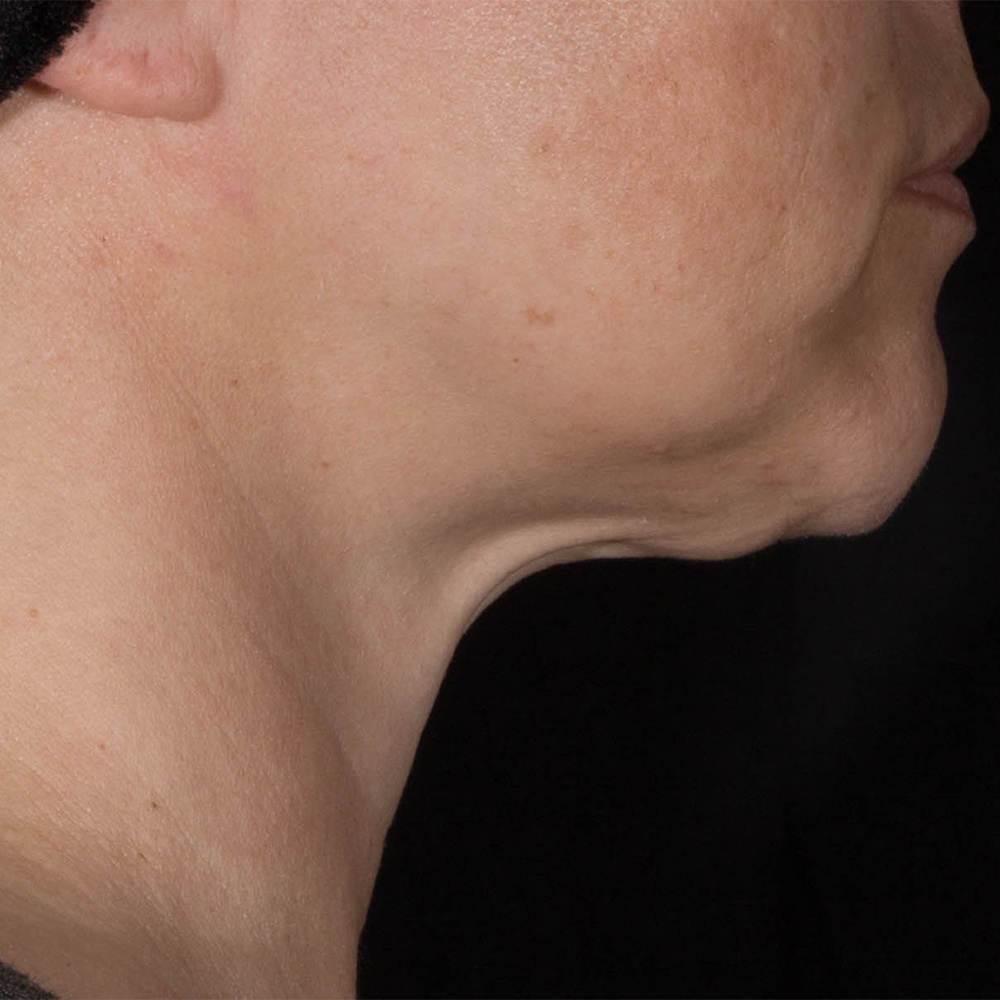 Before Potenza Treatment the neck has reduced elasticity and lower hydration levels