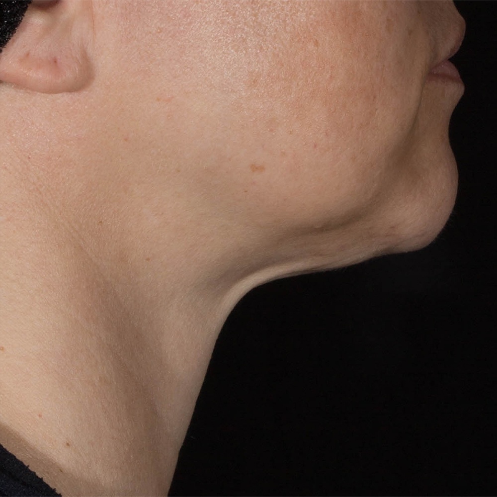 Neck after Potenza Treatment at CLINIQUE AG - Medical Clinic in Laval, Montreal