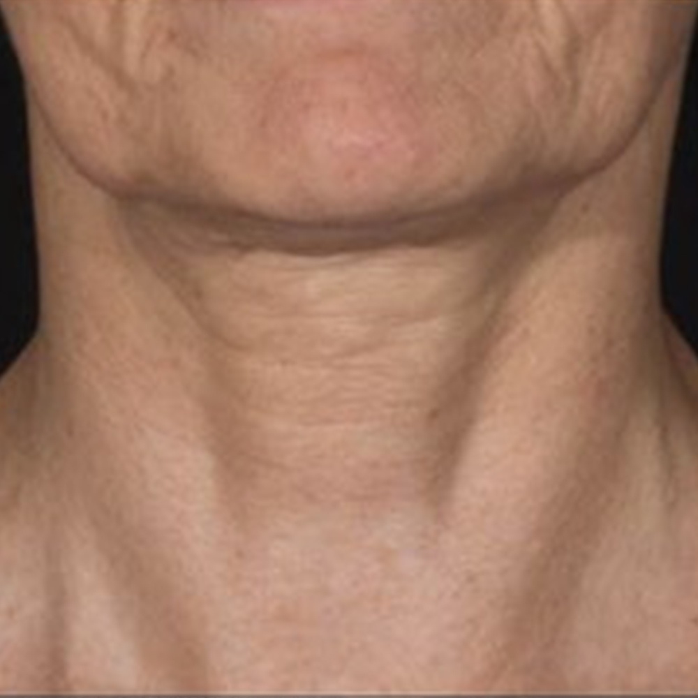 Before Skinbooster Treatment the neck has reduced hydration, roughness and fine lines