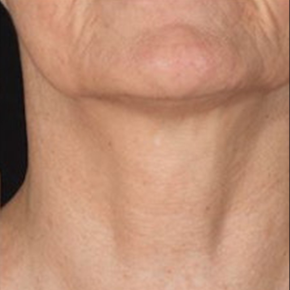 Neck after Potenza Treatment at CLINIQUE AG in Laval, Montreal