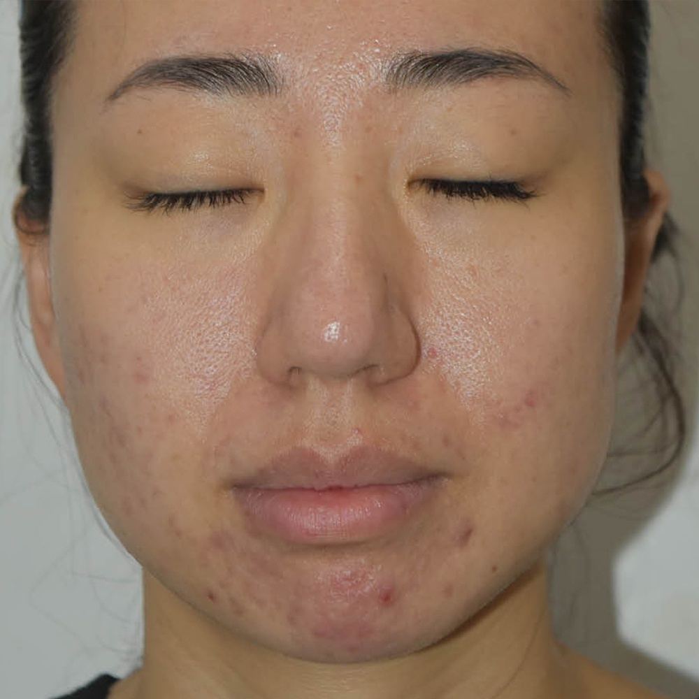 After Potenza Treatment at CLINIQUE AG - Medical Clinic in Laval, Montreal
