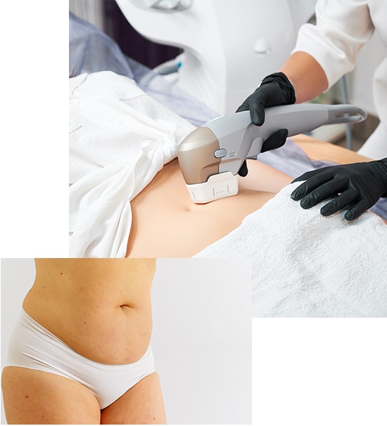 Abdomen Rejuvenation Treatment to eliminate the excess skin and fatty tissue in the lower abdomen