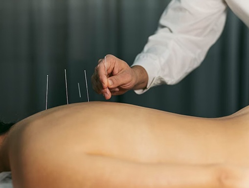 What to Expect During an Acupuncture Treatment: