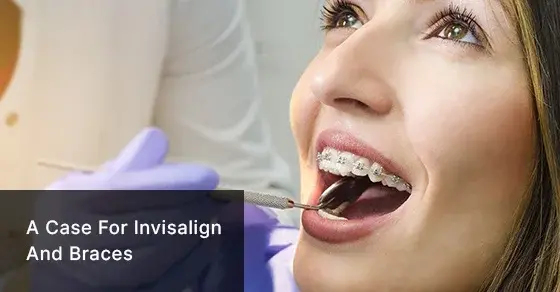 Why Minor Tooth Crowding Can Lead to Gingivitis: A case for Invisalign and Braces 