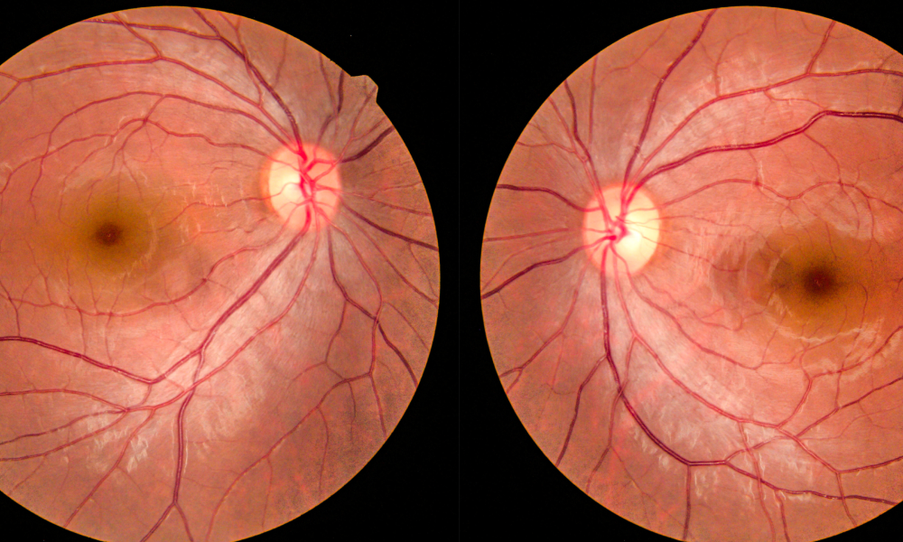 Diabetes And The Eyes - Retinal Imaging Services by Brooklin Vision Care in Whitby