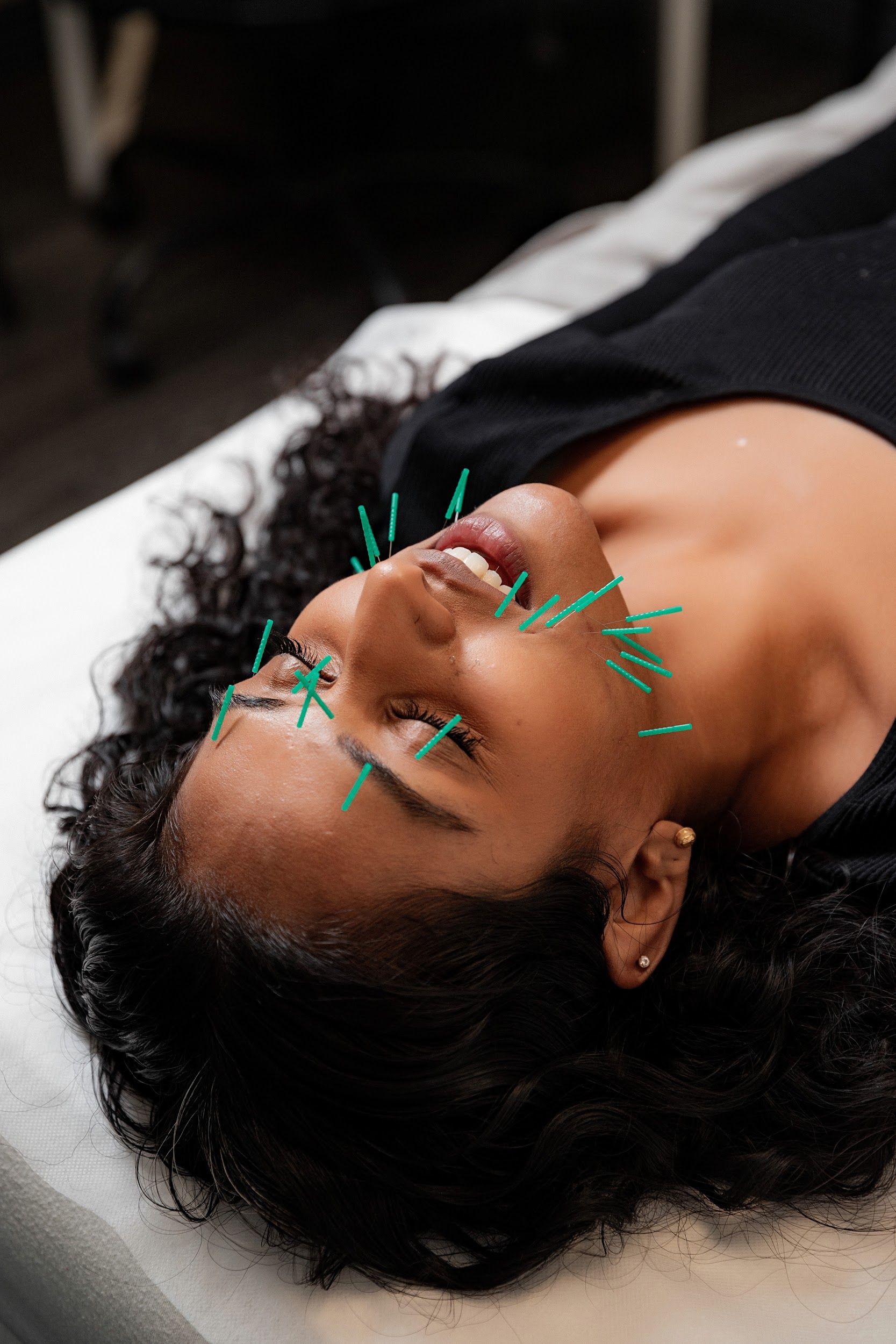 Experience the transformative power of our facial acupuncture treatment at the Osteopathic Clinic in Toronto