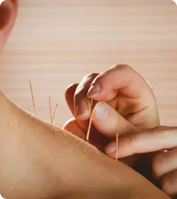 Explore the world of Medical Acupuncture and its potential to enhance health and wellness