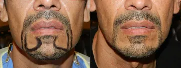 San Francisco Hair Transplant Clinic