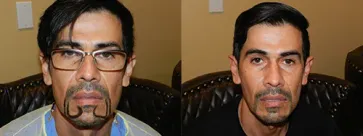 San Francisco Hair Transplant Clinic
