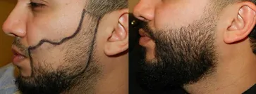 San Francisco Hair Transplant Clinic