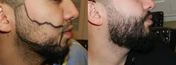 San Francisco Hair Transplant Clinic