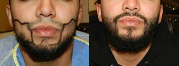 San Francisco Hair Transplant Clinic