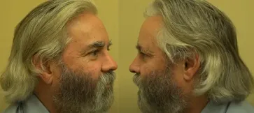 San Francisco Hair Transplant Clinic