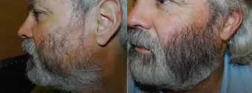 San Francisco Hair Transplant Clinic
