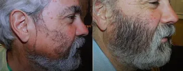 San Francisco Hair Transplant Clinic