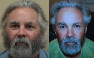 San Francisco Hair Transplant Clinic