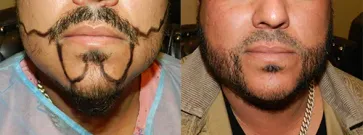 San Francisco Hair Transplant Clinic