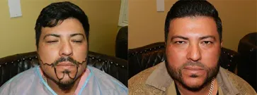 San Francisco Hair Transplant Clinic