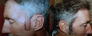 San Francisco Hair Transplant Clinic