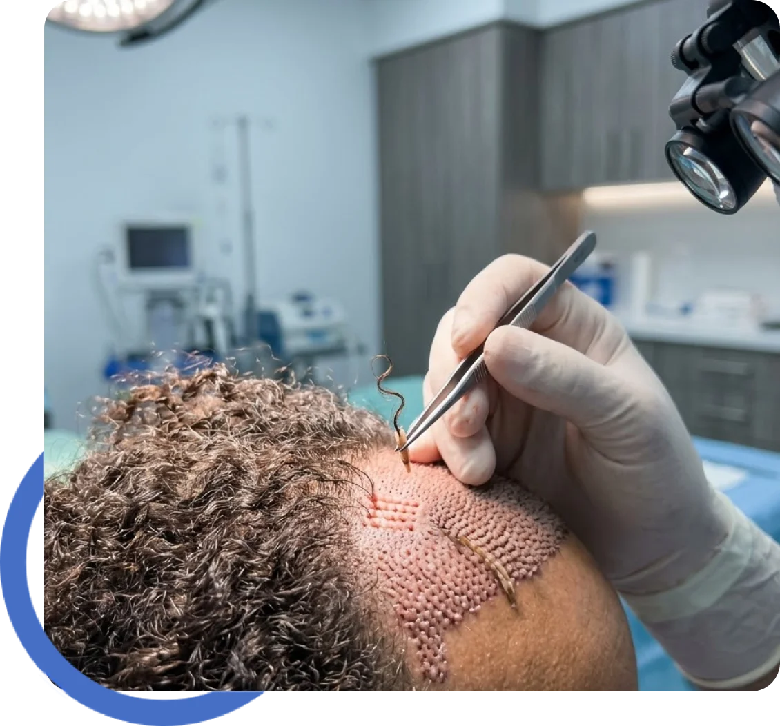 Gender-Affirming Hair Transplant for Santa Rosa Residents