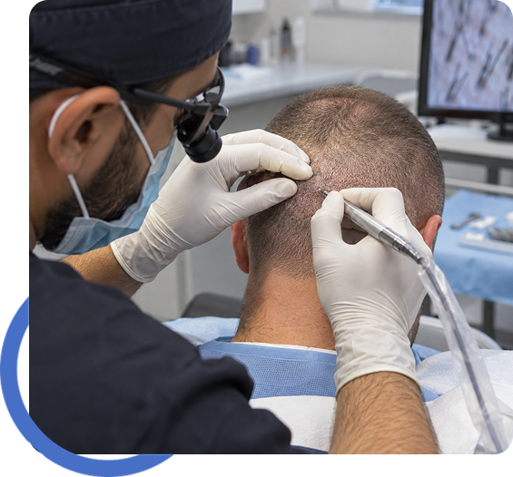 FUE Hair Transplant for Sacramento Residents